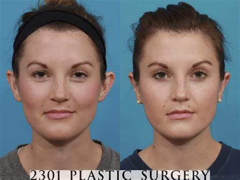 belo otoplasty price|Ear Surgery / Otoplasty .